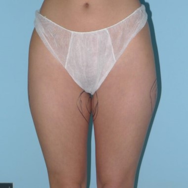 Liposculpture Before in Sydney cost