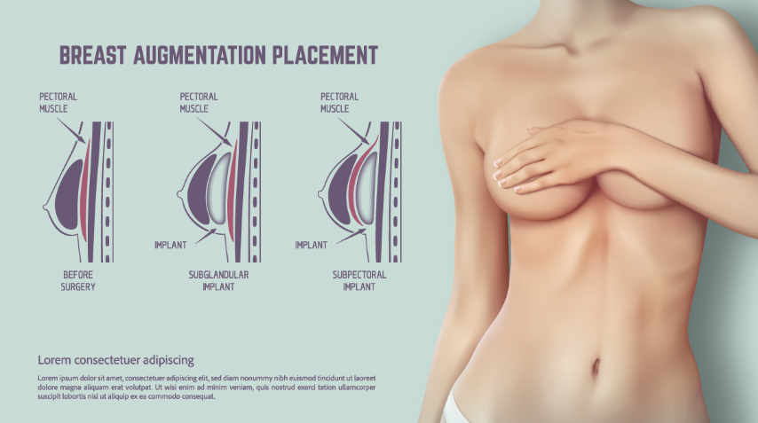 breast implants sydney