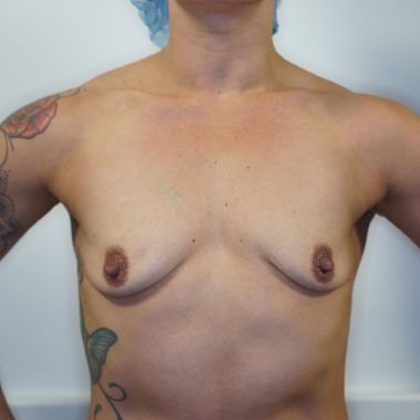 breast lift before after