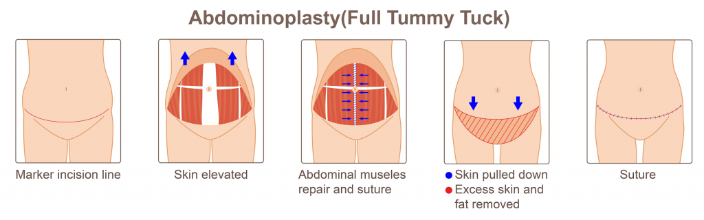 The process of the tummy tuck procedure.