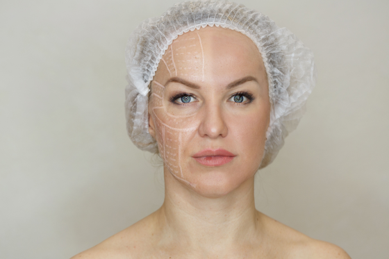 non surgical facelift