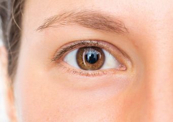 brow lift