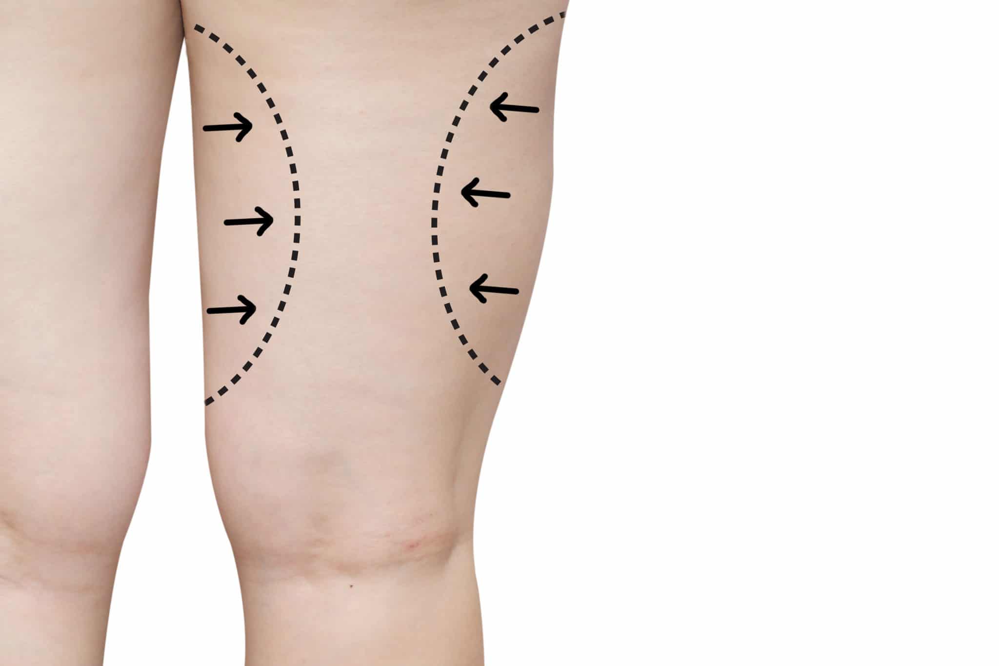 thigh liposuction sydney