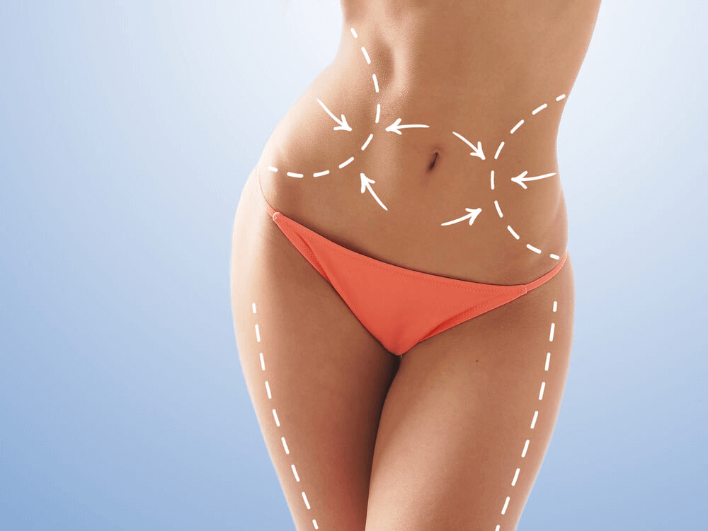 liposuction vs liposculpture liposuction vs liposculpture