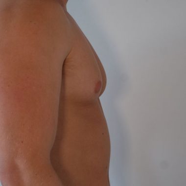 male breast reduction treatment in sydney