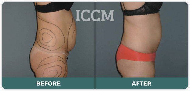 how long does liposuction pain last