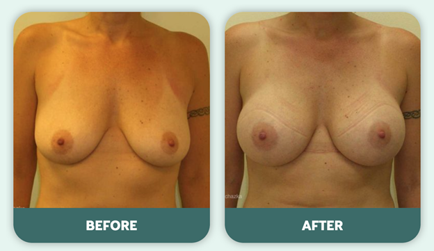 What do I need to buy before breast augmentation