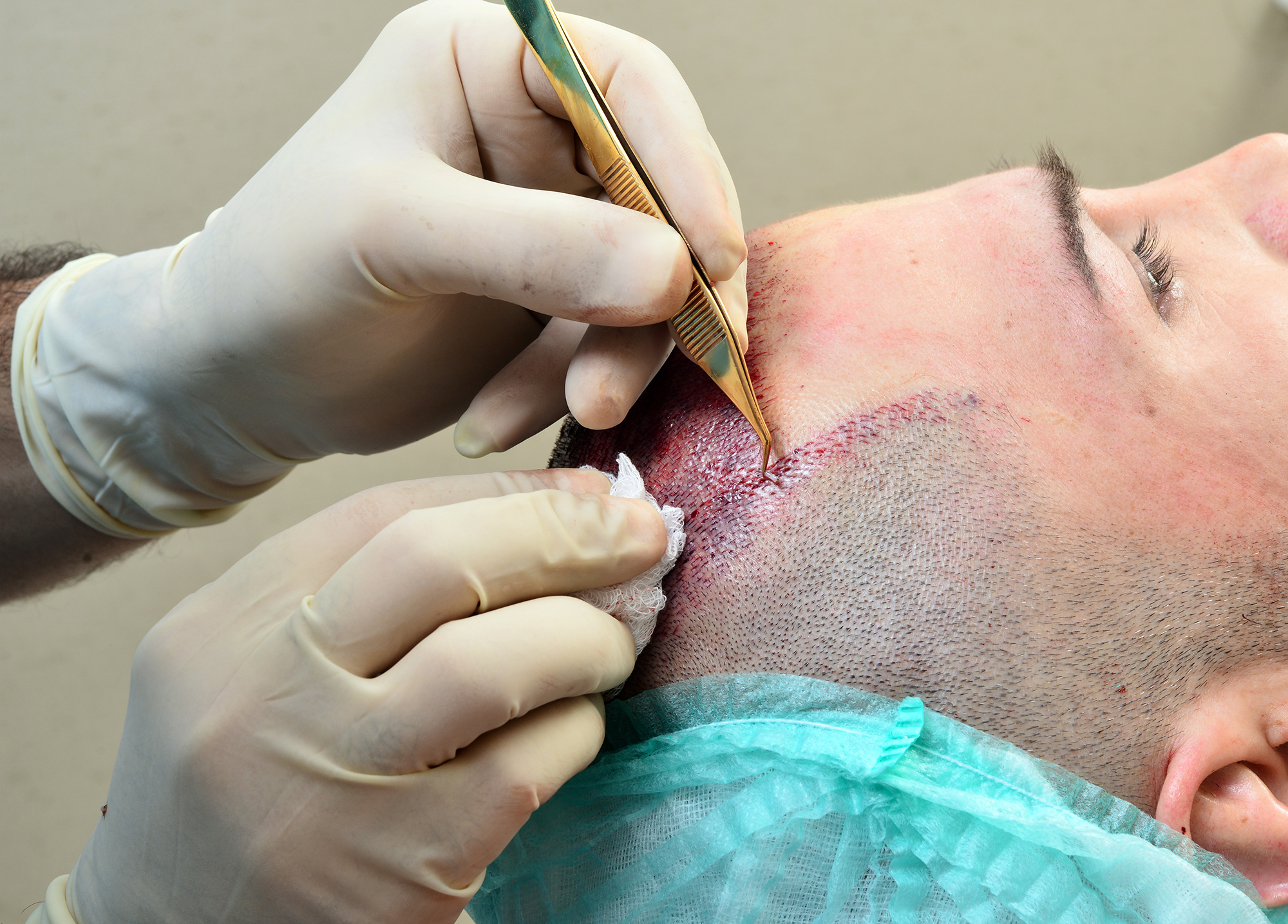 Hair transplant Sydney cost Hair transplant Sydney cost