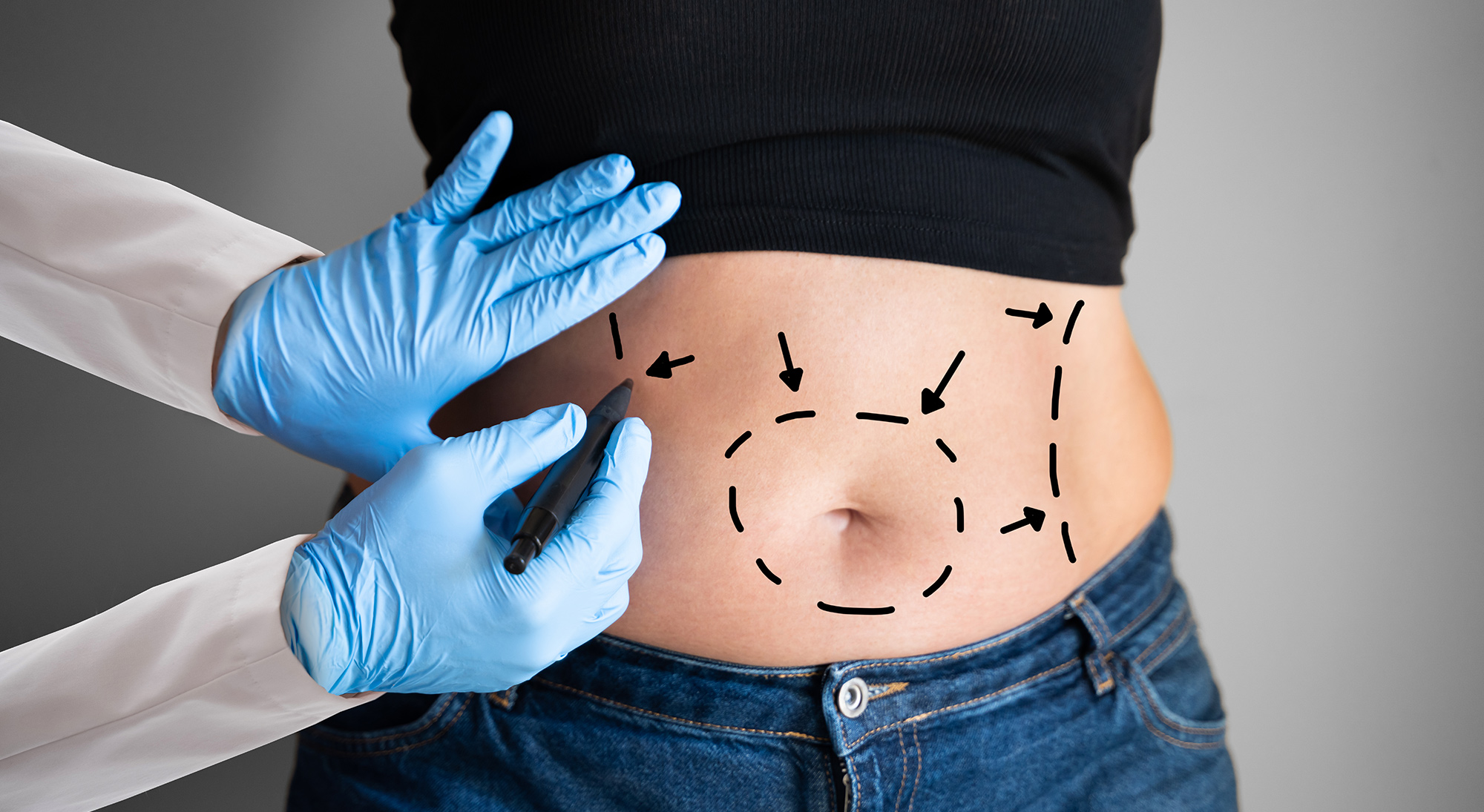fat removal surgery fat removal surgery