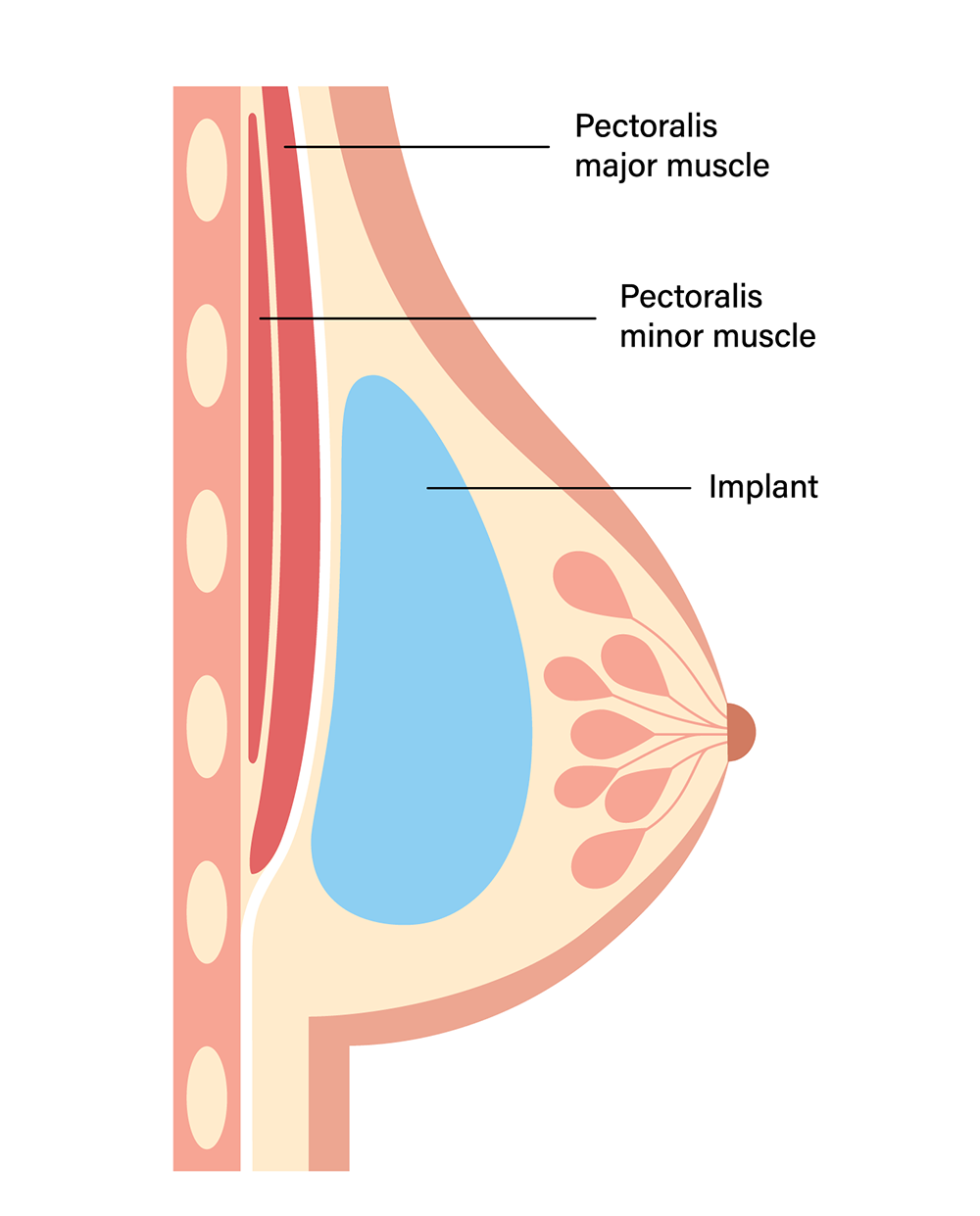 breast implant considerations breast implant considerations